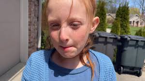 Lydia came out of therapy last werk making a P sound. She has a few more  sounds this week but still no words. It’s great and she is super proud of  herself…..The concern is the sounds are coming from ...