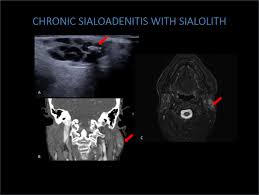 Image result for Sialoadenitis