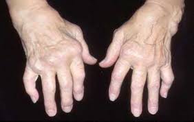 If not diagnosed early and appropriately treated, ra can lead to permanent deformities, disabilities. Rheumatoid Arthritis