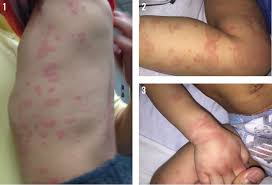 Image result for Generalized Rash