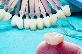 Richmond crown exteriors, lethbridge, ab. Dental Crown Bridges In Richmond Hill Centre Dental