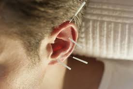 Health Benefits Of Ear Acupuncture