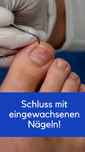 schluss mit eingewachsenen nageln zehennagel eingewachsene eingewachsener nagel fusspilz behandeln