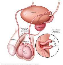 Ask anything you want to learn about vasectomia by getting answers on askfm. Reversao De Microcirurgica De Vasectomia