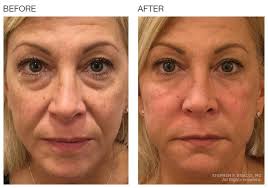 Before After Baselift Botox Fillers Lip Art Makeup Botox Cosmetic