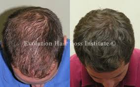 Accepting this reality is the first step towards preventing hair loss from accelerating and getting worse. Before And After Hair Growth Treatment Photos