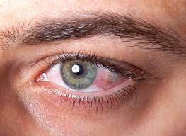 Geplatzte Ader Im Auge Harmlos Oder Gefahrlich Expertenmagazine Com