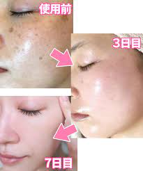 ほぼ全員が７日で実感 皮膚科医の母親が娘のシミを消すためにイタズラな調合 シミの消し方が 神掛かってる と注文殺到 d cosme シミ 化粧品 顔 毛穴 美肌 スキンケア