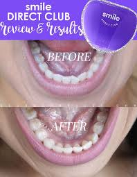 Review Smile Direct Club Before After Smile Direct Smiledirectclub Smile Direct Club Reviews