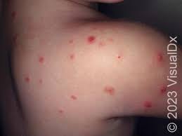 Image result for flea bites