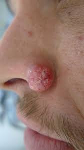 Skin cancer is one of the most common types of cancer. Acd A Z Of Skin Keratoacanthoma