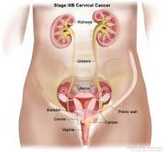 Cervical cancer is a type of cancer that occurs in the cells of the cervix — the lower part of the uterus that connects to the vagina. Cervical Cancer Treatment Pdq Treatment Patient Information Nci Cs Mott Children S Hospital Michigan Medicine
