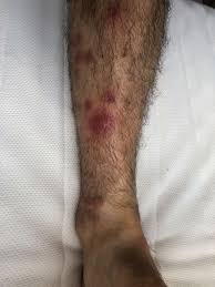 Maybe you would like to learn more about one of these? Guttate Psoriasis Secondary To Covid 19 Bmj Case Reports