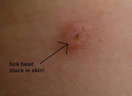 Removing A Stuck Tick Head Tick Removal Ticks Ticks On Humans