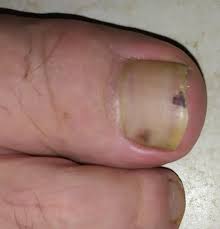 What causes black spots under toenails? Dark Spots On Toenail Of My Big Toe The One On The Top Started In The Lower Third Of The Toenail But Moved Up As The Nail Grew Not Sure If The