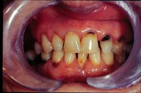 Results from a 2014 study Cavities Mouth And Dental Disorders Msd Manual Consumer Version