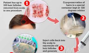 If hair follicles are truly dead, they cannot be revived. Hair Follicles Can Be Banked And Used Later In Life When Balding Appears Daily Mail Online