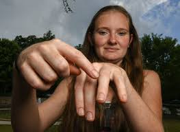 A common sign of a bite from a venomous snake is the presence of two puncture wounds from the animal's fangs. Venomous Snake Bites On The Rise In The Upstate