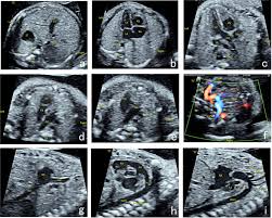 Prenatal Diagnosis And Pregnancy Outcomes Of 1492 Fetuses With Congenital Heart Disease Role Of Multidisciplinary Joint Consultation In Prenatal Diagnosis Scientific Reports