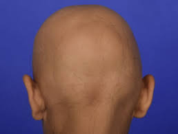 How long does it take to recover after hair patch treatment? Diffuse Alopecia Dermnet Nz