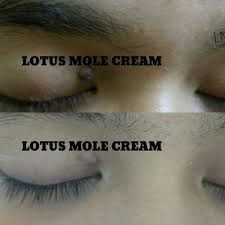 Mampu buang tahi lalat, kutil dan ketuat dlm masa 14 hari sahaja! Buang Tahi Lalat Kutil Biji Kolestrol Dengan Mudah Dengan Lotus Mole Cream Emas Putih