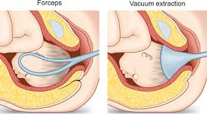 Image result for Forceps Assisted Delivery