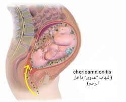 Image result for Chorioamnionitis