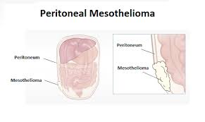 Whether you (or a loved one) are worried about developing malignant mesothelioma, have just been diagnosed, are going through treatment, or are trying to . What Is Peritoneal Mesothelioma Cancer By Abdeslam Ait Hida Medium