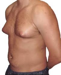 Differential diagnosis for male breast cancer. Gynecomastia Male Breast Reduction Abu Dhabi Breast Surgeries