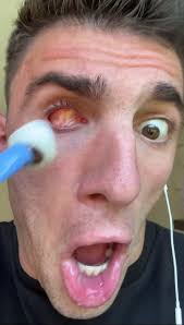 What Happened to the Eye?