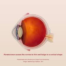 Pin On Keratoconus