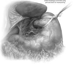 Operation ironside, as the investigation was named, began three years ago as a collaboration between several global law enforcement agencies, including the fbi, the afp, new zealand police. Technique Of Open Ivor Lewis Esophagectomy Operative Techniques In Thoracic And Cardiovascular Surgery