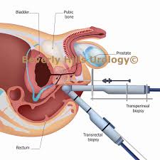 Image result for Prostate Cancer