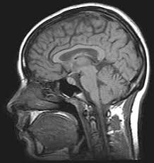 In idiopathic intracranial hypertension (iih) there is raised pressure within the skull (raised intracranial pressure), which puts pressure on the brain. Idiopathic Intracranial Hypertension Wikipedia