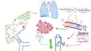 Platypnea Orthodeoxia Syndrome Youtube