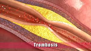 Solfa syllable trombosis venosa profunda. Trombosis Causas Sintomas Y Tratamiento De La Trombosis Guia Medica Familiar