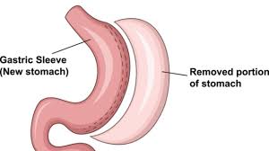 gastric sleeve surgery results how