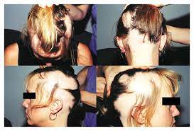 It often results in random hair loss. Hair Loss In Women Nejm