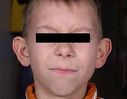 Category:Protuberant ears