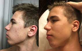 B A 2 Months Of Low Dosage Accutane For Mild Acne 20mg Day 1 Month Left Mild Acne Severe Acne Treatment Accutane