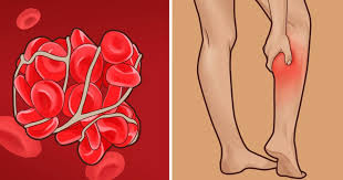 A feeling of warmth in the affected leg. 8 Early Warning Signs Of A Blood Clot To Never Ignore Small Joys