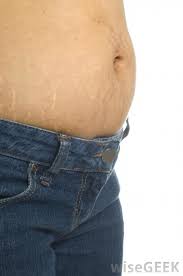 What Is The Best Way To Get Rid Of Stretch Marks