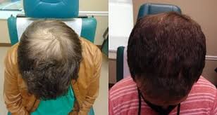 Hi sir i hv done my ht before 5 mnths but now when i do message, small baby hair falling out. Dcigxgpz3rw04m