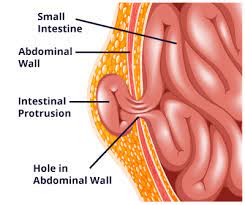 Maybe you would like to learn more about one of these? What Is A Hernia Types Symptoms Treatment And Prevention