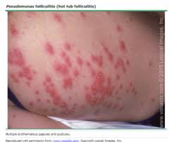 At the same time, sanitizer levels that are too high increase your risk for chlorine pool rash or bromine rash. Hot Tub Pseudomonas Folliculitis Treatment
