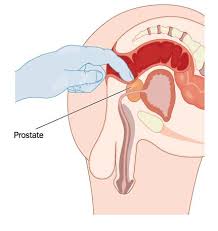Image result for Prostatitis General Measures