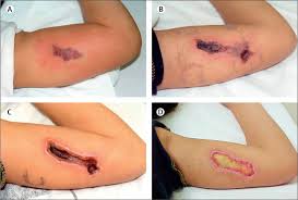 Image result for Spider Bite