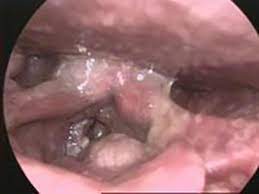 Life threatening tonsil cancer symptoms include: Throat Cancer Symptoms Pictures Causes And Treatment