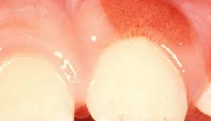 We did not find results for: Swollen Gum Around One Tooth Causes And Treatment