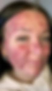 Her body was itchy, he thought it was an allergy, they diagnosed him with  ca... read more in comments